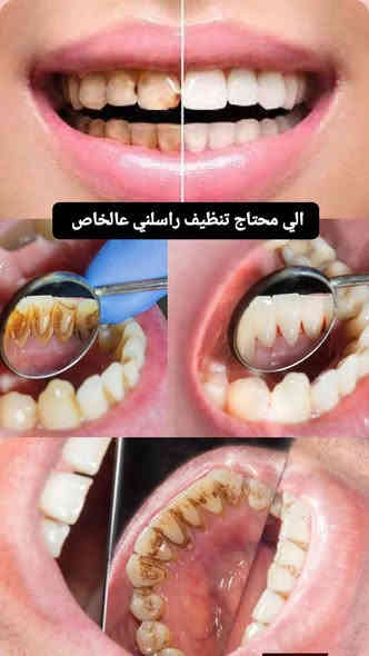 من رخصة الأمن
السلام عليكم شلونكم شباب إن شاء الله بخير💐 ، اي شخص يحتاج حشوة ، قلع ، تنظيف ، أو فحص لاسنانه او حالته مشابهه للصور المرفقة وتحتاج علاج خل يتواصل وياي على الخاص او على الواتساب *********** و حته احجزله فوراً علما أنه العلاج مجاني و تحت إشراف كادر طبي متخصص جدا في كلية طب الأسنان جامعة القادسية .
