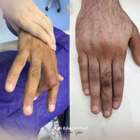 حالة اليوم ⚕️ حالة اصابة الوتر الباسط للاصبع الوسطى مع تأخر في العلاج ...