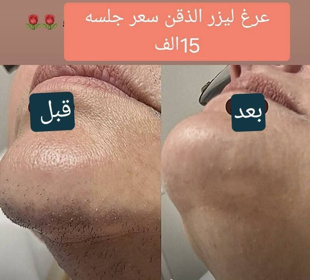 🔥✨ بمناسبة عيد الضحى ✨🔥
💆‍♀️ تسوين حف + بشرة
💇‍♀️ تسوين صبغ + ميش
وغيرها هوايــــة عروض ومفاجآت داخل السنتر ✨💖
⏰ العرض مستمر فقط لغاية الساعة 4 العصر
🚨 لا تفوتون الفرصة والبنات دللو نفسكم ويانه
━━━━━━━━━━━
✨🌸 أقوى عروض عيد الأضحى المبارك 🌸✨
من داليا بيوتي 💖
دللي نفسج بأفخم الخدمات وأقوى الأسعار 🔥
💇‍♀️ عروض الشعر 💇‍♀️
✨ صبغ ميش للشعر القصير (الكاريه) — 15 ألف فقط
✨ صبغ فقط — 10 آلاف فقط
✨ صبغ ميش للشعر الوسط للكتف — 25 ألف فقط
✨ صبغ فقط — 15 ألف فقط
💖 الشعر الطويل والثخين
عليه خصومات قوية داخل السنتر 😍
✨ تخصيل جميع الأطوال
ماعدا الشعر الطويل — 35 ألف فقط
✨ عروض البروتين — 25 ألف فقط
يعالج الشعر التعبان والمتقصف والمحترك والمطاط ✨
━━━━━━━━━━━
💃 عروض التسريح 💃
✨ تسريح للشعر القصير — 20 ألف فقط
✨ تسريح للشعر الوسط للكتف — 30 ألف فقط
💖 الشعر الطويل والثخين
عليه خصم مميز داخل السنتر ✨
━━━━━━━━━━━
👁️ عروض الرموش 👁️
✨ رموش طرفية — 5 آلاف فقط
✨ رموش كاملة — 10 آلاف فقط
━━━━━━━━━━━
🌸 خدمات الوجه والعناية 🌸
✨ حف — 5 آلاف فقط
✨ شمع للوجه — 5 آلاف فقط
✨ شمع للرقبة — 5 آلاف فقط
✨ تنظيف قدم — 5 آلاف فقط
✨ تنظيف أيد — 5 آلاف فقط
✨ تنظيف بشرة — 5 آلاف فقط
✨ هايدروفيشل — 5 آلاف فقط
✨ تقشير كاربوني — 5 آلاف فقط
━━━━━━━━━━━
💖 عروض الشيرة 💖
✨ شيرة بكيني — 5 آلاف فقط
✨ شيرة الإبط — 5 آلاف فقط
✨ شيرة الرقبة — 5 آلاف فقط
شيرة جسم كامل 15  الف
━━━━━━━━━━━
💅 عروض الأكرلك والأظافر 💅
✨ أكرلك + جلش + دزاين — 15 ألف فقط
✨ جلش فقط — 5 آلاف فقط
✨ دزاين فقط — 5 آلاف فقط
━━━━━━━━━━━
✨ عروض الليزر ✨
✨ ليزر الوجه — 10 آلاف فقط
✨ ليزر البكيني — 10 آلاف فقط
✨ ليزر الإبط — 10 آلاف فقط
━━━━━━━━━━━
🌸✨ افتتاح فرعنا الثاني ✨🌸
سوينالكم عرض خاص اليوم وباجر والسبت فقط 💅
🔥 أكرلك + جلش + دزاين بـ 15 ألف 
شيرة جسم كامل 15 :
بغداد الجديدة —✨
📌 الفرع الثاني:
بغداد الجديدة — نعيريه✨
فرع كنيسة مريم العذراء 
فرع سكلة الامي 
📞 للاستفسار والحجز:
*********** — واتساب متوفر 
@إشارة ✨️ عروض العيد  ✨️
تغيير شامل فلر كوري 150الف  مع ابرة نضاره
#تغيير_للأفضل #تغيير_شامل #تفتيح
