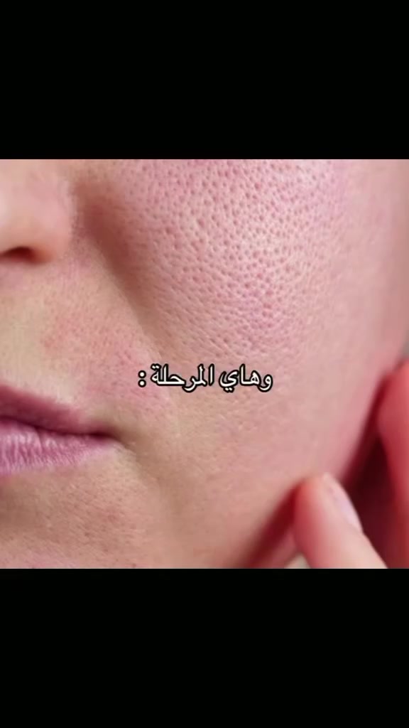 عندج حبوب أو رؤوس سوداء؟ هذا العرض الج يا حبيبتي! 🔥 الحساب مالتنا يوفرلج أقوى بكج متكامل لحل كل مشاكل بشرتج بوقت قياسي وبنتيجة مضمونة 💯✨ للحجز والاستفسار راسلي الصفحة الآن 💌


**إذا كنت صاحب هذا الإعلان وتريد حذفه لأي سبب، رجاءا أرسل رسالة إلى الدعم الفني**