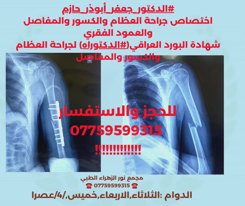 💚الدكتور جعفر ابوذر حازم
12 ديسمبر 2023
 ·
✨️✨️✨️كسر منتصف عظم العضد✨️✨️✨️
                                ➖️➖️➖️➖️➖️
🔴 زارنا مريض تعرض لسقوط من مرتفع إلى كسر في منتصف عظم العضد الايسر.
🟡 بعد إكمال فحوصات المريض واخذ الرقائق الشعاعية ، تم إجراء عملية ارجاع و تثبيت كسر عظم العضد الايسر باستخدام صفيحة البلاتين والبراغي، مع سلامة العصب الكعبري في منطقة الكسر بعد العملية.
            〰️〰️▫️▫️▫️〰️〰️▫️▫️▫️〰️〰️
#الدكتور_جعفر_أبوذر_حازم 
✅️️️اختصاص جراحة العظام والكسور والمفاصل والعمود الفقري
✅️️شهادة البورد العراقي(#الدكتوراه) لجراحة العظام والكسور والمفاصل
✅️️عضو الجمعية السويسرية للاصابات الرياضية 
✅️️عضو الجمعية العالمية للعمود الفقري 
للحجز والاستفسار
#
☎️   ***********
مجمع نور الزهراء الطبي
☎️ *********** ☎️
الدوام :الثلاثاء,الاربعاء,خميس,/4/عصرا
