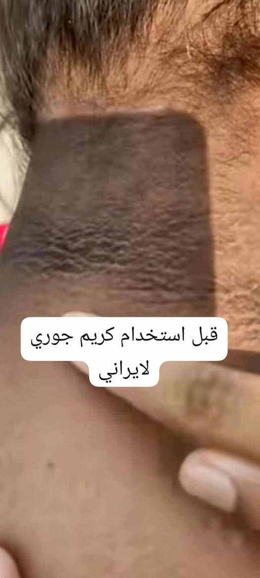 📣 عاجل  "جوري سكين الايراني"! بـ 18 ألف وبس والتوصيل بلاش!!! 📣 توفر توصيل داخل العراق الأول مره. 
بنات، أستغلو ا العرض@ شفتوا هاي الصور اللي بالمنشور؟ ، هاي حقيقة واقعية! نتائج تجنن وصدمة حقيقية لزبوناتنا اللي قرروا ينهون معاناتهم مع مشاكل البشرة! 💯💥
تعبتي من حب الشباب وآثاره اللي مخربة وجهج؟
سوّيتي تقشير وندمتي لان سوالج تصبغات؟ 
المناطق الحساسة والركب والأكواع مسببت لج إحراج؟ (شوفي الصورة 
تردين بشرة زجاجية ونعومة خيالية مثل "الكيمر"؟ 
الحل السحري لكل مشاكلج صار بين ايدج! 😉
مقشر جوري سكين مو بس مقشر، هو الحل النهائي والجذري! بتركيبة فريدة تشتغل على عمق البشرة، تجددها، تفتّحها، وتخفي كل التصبغات والآثار. ✅✨
عرض "جوري سكين" الذهبي (اللي ما يتكرر):
بمناسبة العطلة، ولأننا نحب نفرحكم، سوينا الكم أقوى عرض بالعراق:
🎁 مقشر جوري سكين بـ 18 ألف دينار بس!!!
🎁 والتوصيل مجاني لكل مناطق العراق!!!
أي نعم، التوصيل بلاش عليكِ! يعني بس تدفعين 18 ألف والمقشر يوصلج لبيتج! 🚗💨
لحكي، لا تضيعين الفرصة! الكمية محدودة جداً والطلب هواي، والكل يريد يجرب النتائج الحقيقية! 🏃‍♀️🏃‍♀️🏃‍♀️
احجزي مقشرج الآن ببلاش التوصيل! راسلينا على الخاص
#جوري_سكين #بشرة_زجاجية #نتائج_حقيقية #قبل_وبعد #تفتيح_المناطق_الحساسة #عناية_بالبشرة #حب_الشباب #آثار_حب_الشباب #تصبغات #عرض_العطلة #توصيل_مجاني #العراق #ميسان #بغداد #البصرة #اربيل #اكسبلور #تريند #جمال #نعومة #كيمر


**إذا كنت صاحب هذا الإعلان وتريد حذفه لأي سبب، رجاءا أرسل رسالة إلى الدعم الفني**