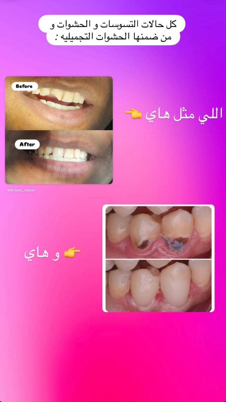 السلام عليكم .. مجاناُ مجاناُ
تعلن عيادات طب الاسنان في جامعة دجلة عن استقبال المراجعين لعلاج الحالات التاليه مجاناً  : 
● علاج الاسنان المتسوسة بالحشوات التجميليه.
● تنظيف الاسنان و ازالة التكلسات .
● قلع الاسنان و جذور الاسنان.
●تعويض الاسنان المفقودة بطقم جزئي متحرك .
العنوان : مستشفى طب الاسنان _ داخل جامعة دجلة.. 
للتواصل : هاتف ، واتساب ، تليكرام ‎***********
انستغرام : dr.fawz_mazin
