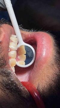 مستمرين بعروضنا داخل العيادة للحجز و الاستفسار 07744466629