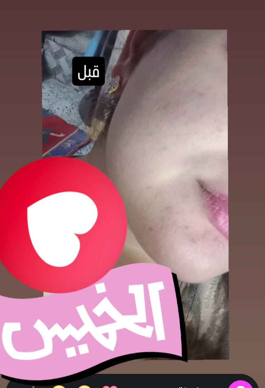 يسعد مسائكم ياحلوات ☺️ شوفولي نتائج سيروم الخلايا الجذعيه هاي نتيجته بس 3 ايام فقطط وهيج النتيجه جنننن لاخلطات ولاشي عالجي بشرتج وانتي مطمئنه بسيرومات تغذيه علاجيه عشبيه نضارة الي ينطيه عبالك حاقنه ابرة نضارة شررط من غير الصفاء والتصبغات كله يعالجه وتدللون عليه 😉😉😉


**إذا كنت صاحب هذا الإعلان وتريد حذفه لأي سبب، رجاءا أرسل رسالة إلى الدعم الفني**
