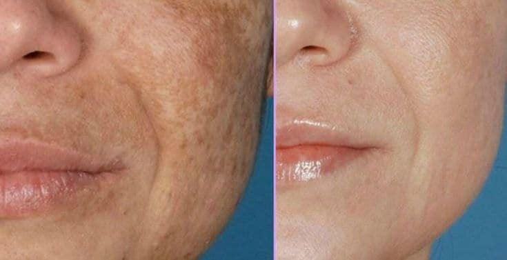 🌸 سر البشرة النقية أصبح بيدك
مع سيروم نيساميند 10 ستحصلين على عناية مركزة تساعد على تهدئة البشرة، تقليل آثار الحبوب، ومنحك إشراقة طبيعية بدون فلاتر.
خطوة واحدة تضيف لروتينك لمسة احترافية ونتيجة تُلاحظ بسرعة.
لا تنتظري التغيير… اصنعيه اليوم وامنحي بشرتك ما تستحقه.


**إذا كنت صاحب هذا الإعلان وتريد حذفه لأي سبب، رجاءا أرسل رسالة إلى الدعم الفني**