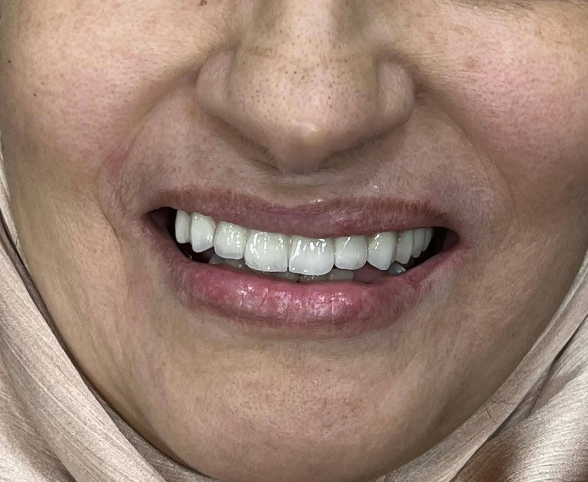 ابتسامة  ساحره وثقة مضاعفه 🩵🔥 عيادتنا فرع حي النصر 🔥🔥

تعويض الاسنان باستخدام (جسر زاركون ألماني) لمراجعتنا من المشتل 
وتم تعويضها ب اسنان 
- الزاركون ايماكس  الدائمي( الألماني) 
على يد الطبيب الاختصاص
د.محمد منصور 
(ماجستير في طب ومعالجة الاسنان) 

أبتسامتك ~ يم عيادات الفرح لطب وتجميل الأسنان ~ غير ✨😍

علماً كافة الابتسامات والحشوات مع ضمان مدى الحياة 😎

للإتصال 📞📞 
فرع حي النصر

*********** ☎️

دوام العياده ⏰
فرع حي النصر 
من الساعه 5  عصرا 
إلى 
الساعه 10 مساءا
