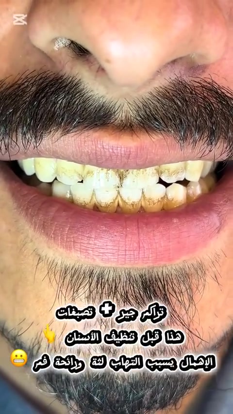 يمكن ماسامع بدكتور يكلك دخن براحتك .. 
اسمعها من عدنه (دخن براحتك ) بس حافظ 
على ابتسامتك لان انت تستحق اطلالة حلوة : 
شنو منتضر زورنا هسه قبل ليفوت الاوان !! 
عنوانا 
بدرة : الشارع العام : قرب الدكتورة اطياف : العمارة الجديدة 
تنورونا بمركزنا مركز لؤلؤة بدرة لطب وتجميل الاسنان 
واذا حبيتوا تتواصلون وتستفسرون اتصلوا على الرقم 
***********
ومليون هلا بيكم ❤️
