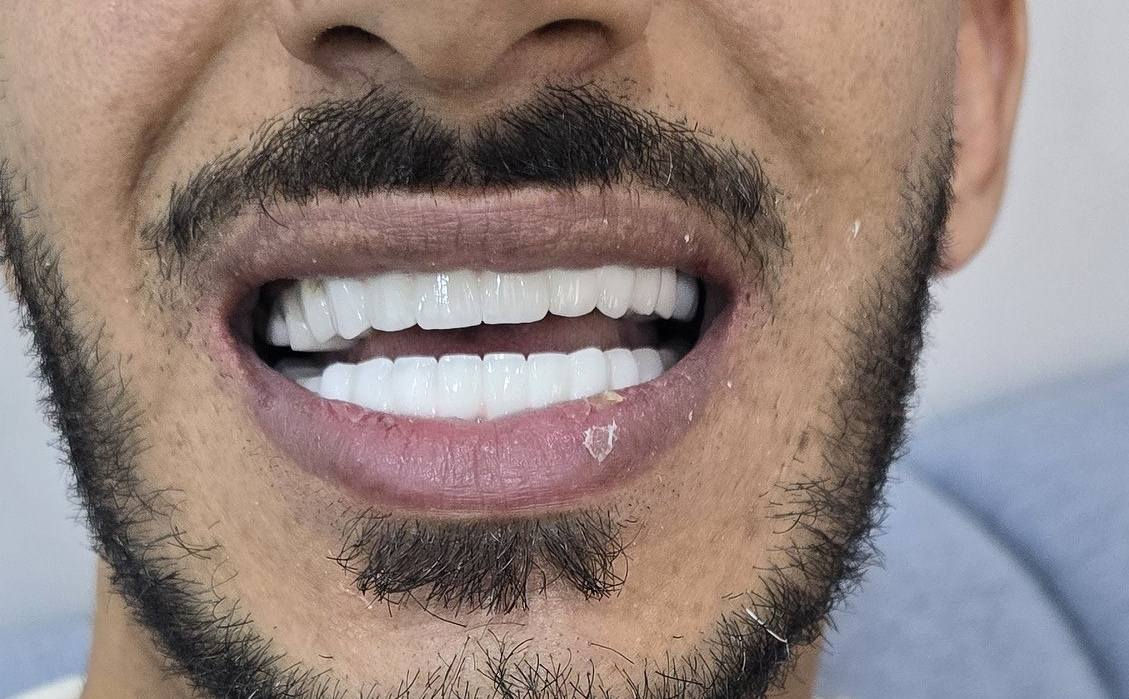 سلام عليكم ورحمة الله وبركاته
اسعد الله اوقاتكم 
وكل #عام_وانتم_بالف_خير
المختبر الابداع السوري  لصناعة الاسنان
و التعويضات السنية وتركيب الأسنان
وبأنسب الاسعار بجميع المحافظات
العراقية 
ملاحظة لدينا كادر يزور المريض للبيت ويتم العمل في المنزل 
للتواصل والحجز. ***********»꧁꧂«***********
