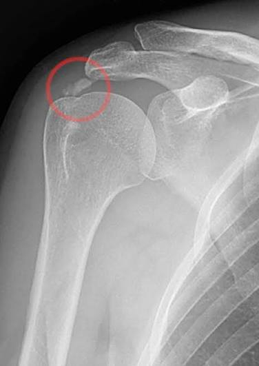 التهاب الاوتار التكلسي Calcific tendonitis 

يركز علاج التهاب الأوتار التكلسي على تخفيف الألم والالتهاب بواسطة :

✅العلاجات التحفظية

🔴الراحة والكمادات الباردة/الدافئة: الحد من النشاط ووضع كمادات باردة أو دافئة على المنطقة المصابة.

🔴الأدوية: تساعد مضادات الالتهاب غير الستيرويدية (مثل الإيبوبروفين) ومسكنات الألم في السيطرة على الالتهاب والألم.

🔴حقن الكورتيكوستيرويد: حقن الستيرويد مباشرة في الوتر لتخفيف الألم والالتهاب الشديدين بسرعة.

🔴العلاج الطبيعي: تمارين لتقوية العضلات وتحسين حركة الكتف/المفصل.

 ✅✅✅العلاج بالموجات الصدمية خارج الجسم (ESWT): تعمل الموجات الصوتية عالية الطاقة على تفتيت ترسبات الكالسيوم لتعزيز الشفاء.

✅✅✅الموجات فوق الصوتية العلاجية: تستخدم موجات صوتية عالية التردد للمساعدة في تفتيت الترسبات.

🟥العلاج الجراحي (نادرًا ما يكون ضروريًا)

  العنوان
بغداد 
الأمين2 
شارع النواب مقابل كراج سوق الشهداء 
***********
