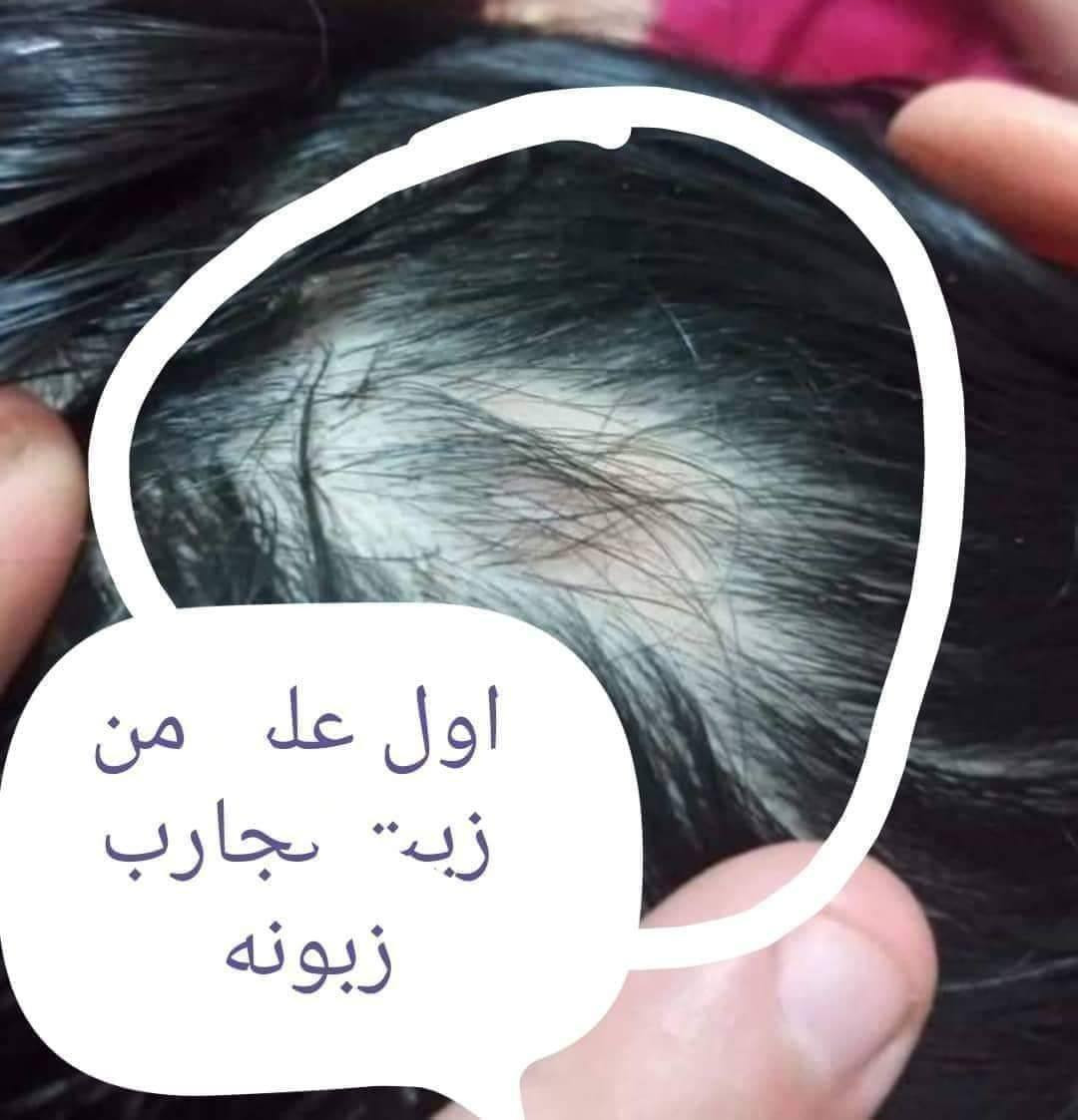 خلال سبوعين سبوعين لااكثر إذا مصار شعرج هيج أن بلخدمه
يطول شعر بشكل فضيع 😍✌️🏻

يمنعلج التساقط 

يكثف شعرج 

وينعمه ويلمعه شتريدين بعد أكثر سندوسه😉💜

يصير شعرج بطولج بالله العظيم 😍✌️🏻   دخذي واحد والثاني كد ماراح يعجبج الزيت غصب عليج راح ترجعين وتشترينه مني 🙊🥺😍وتوصيل لجميع محفظات 🚗🔥 بقيه البيجات عزلوا احسسلكم👍🏻❌

تعاي خاص ومعليج بل باقي توصيل جميع لمحفظات موجود لحجز ع خاص امنت الله ورسوله زيت مجرب وجربت ع شعري ومشالله نصحكم بيه كلش تاخذي تدعلي شرط ولله علفرق يشهدلله يجننن يجننن


**إذا كنت صاحب هذا الإعلان وتريد حذفه لأي سبب، رجاءا أرسل رسالة إلى الدعم الفني**