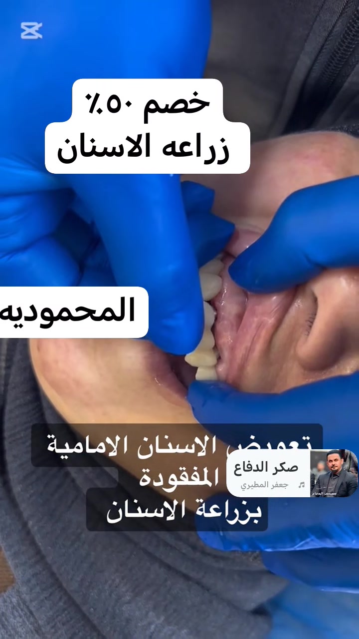 🌟 عرض الجمعة الذهبي 🌟
🦷 زراعة الأسنان
🦷 تقويم الأسنان
🦷 تنظيف وتبييض بالليزر

⚡️ خصم 50% فقط يوم الجمعة
💳 مع توفر نظام أقساط مريح

📍 العرض حصري – سارع بالحجز ولا تفوت الفرصة!

العنوان المحموديه الحجز واتساب *********** واتصال ***********
