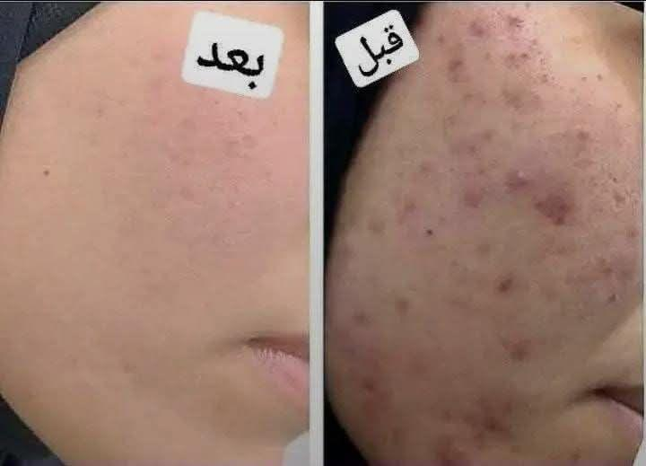 اقوى خلطة تبيض  وجه معجزه امانه الله 

اقوئ العروض وتخفيضات مده يومين تحطيم اسعار سعر جمله منتج يخبل والله العظيم

مخلوطه من18نوع من كريمات طبيه  بنوعيتين مسمن وبدون مسمن مورد وبدون مورد يستخدم للوجه والجسم بنفس وقت 
كلف نمش حب الشباب تصبغات هالات تحت العين  
  والاسعار ويانا نار 🔥

نتائج واضحة بيومين  من الاستعمال
فوائد الخـــلطــــــة

  ازالة التصبعات
- ازالة اكلف والنمش
- ازالة التجاعيد ( ان وجدت )
- ازالة هالات السوداء تحت العين 
-  تضيق المسامات
- ازالة حب الشباب  واثاره
🌹🌹🌹🌹🌹🌹🌹
خلال ثلاث ايام مفعول ملحوظ جدا 

امانه الله مجربه مضمونه وعن تجارب السعر  20  توصيل مجاني 

الحجز مراسلة الصفحة
التوصيل مجاني لكافة محافظات العراق بغداد, العراق


**إذا كنت صاحب هذا الإعلان وتريد حذفه لأي سبب، رجاءا أرسل رسالة إلى الدعم الفني**