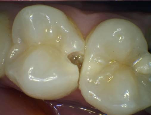 الي عندة مثل هيج تسوس يصير بجانب السن
يتفضل بحجز اعالجهن الة مجاني 
باجر عندي امتحان ومطلوب مني هيج حالة
عنواني كربلاء_خلف مول الحارث
رقمي واتساب ***********
