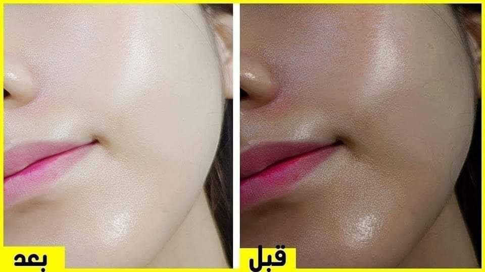 السلام عليكم شباب بنات عيوني
وصلتني وجبة من المبيضات البشرة والمسمنات والمنحفات أمنة ومرخصة من الصحة و منتجات عناية بالجسم وتبيضه ومكياج. واسويلكم عليها عروض واسعارها معقولة مقارنة مع أسعار السوق للحجز والاستفسار مراسلة الصفحة الرئيسية وتدللون وفرتلكم عروض رهيبة بس كولي شنو مشكلتج / ك .. اومن شنو تعانون
               ختارو رقم والحل يمي🎀
1/تنحيف 
2/مسمن
3/كلف 
4/تصبغات وحبوب 
5علاج التساقط الشعر 💇‍♀️ 
6/علاج تبيض الجسم والواجه 
7/العنايه بلقدمين 
8/العنايه بليدين 
9/علاج للهلات تحت العين 👁 
10/تسريح الشعر 
11/مسمن وجه فقط 
12/لتكثيف الحواجب والرموش 
13/رفع وشد وتكبير الصدر 
14/رفع وشد الأرداف 
15/تبيض المناطق الحساسة 
16/التخلص من الكرش والدهون 
17/التجاعيد 
18/نفخ الشفايف 
19/نفخ الخدود
20/العنايه بالجسم 
او استشارة طبية مجانية لعلاج مشاكل كثيرة واولها البشرة والشعر والجسم 
اي شي تريدو دزولي ياه ع خاص ارد عليكم


**إذا كنت صاحب هذا الإعلان وتريد حذفه لأي سبب، رجاءا أرسل رسالة إلى الدعم الفني**