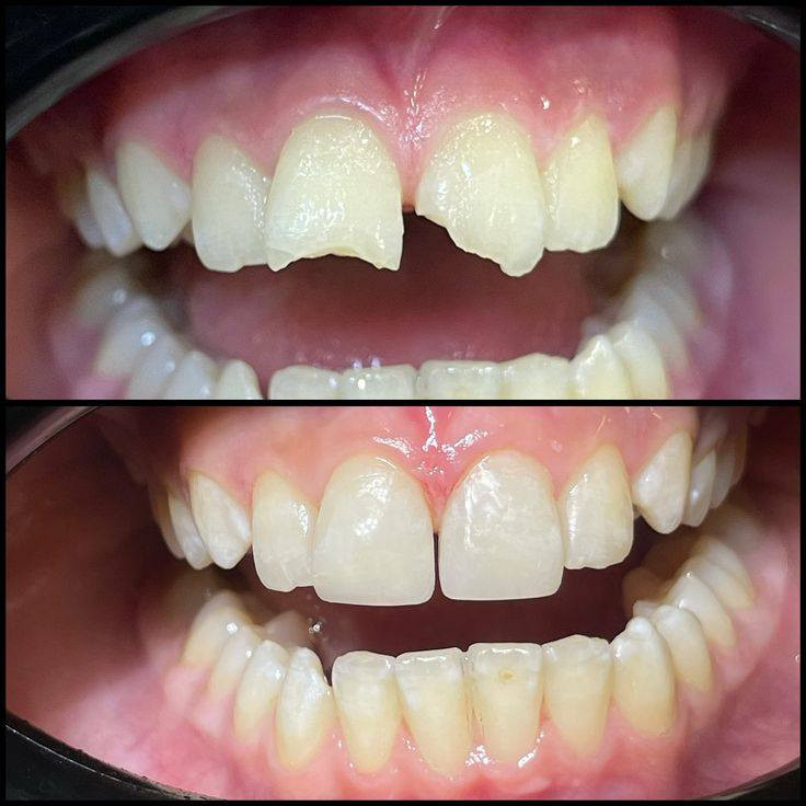 ‏‪تعلن جامعة اهل البيت عن استقبال الحالات التاليه 📌مجانا وباشراف الاطباء الاختصاص:
🛑قلع الاسنان والجذور التالفه 
🛑تنضيف الاسنان من التصبغات والتكلسات 
🛑حشوات تجميليه  للاسنان الاماميه المكسورة أو تسوس بسيط، للحجز  اترك تعليق وسيتم الرد عليك او مراسله على الرقم 👇🏻
واتساب :📞‏‪***********‬‏
📍موقع الجامعه كربلاء -شارع الحر الصغير
