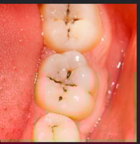 علاج مجاني • حشوة ضوئية • قلع أسنان