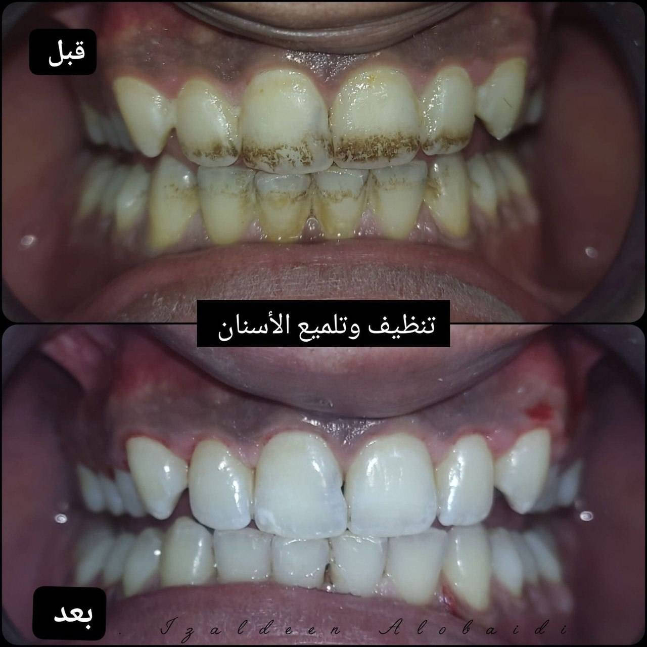 ✨ لأن ابتسامتك تفرق… إحنا نهتم بيها ✨
🦷 عيادة الدكتور د. احمد عَراك   لطب الأسنان
تعلن عن تخفيضات خاصة على جميع إجراءات الأسنان
بأيدي خبيرة، عناية دقيقة، وأسعار تناسب الكل 🤍
🔹 التغليفات:
• السيراميك: 50 ألف
• الزركون: 60 ألف
🔹 تنظيف الأسنان:
• 10 آلاف بدل 25 ألف
🔹 الحشوات التجميلية:
• 10 آلاف للسن الواحد
🎁 وعند عمل جلستين حشوات، جلسة تنظيف مجانية
لأن راحتك وصحة أسنانك تهمّنا، وفرنالك أفضل العلاجات بدون تأجيل
خلّي ابتسامتك اليوم أحلى من باچر 😁🦷
📍 العنوان: بغداد – الحسينية
مدخل التكاسي، مجاور لحوم الحسنات
📞 يرجى الحجز مسبقًا لتثبيت الموعد:
***********
