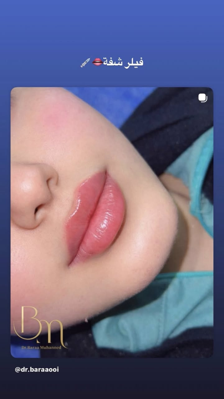 استغلوا عروض العيد من عيادة اوليفيا للتجميل
العنوان : الجريخي مجمع الصدرين الطبي الطابق الثاني 
٠***********
