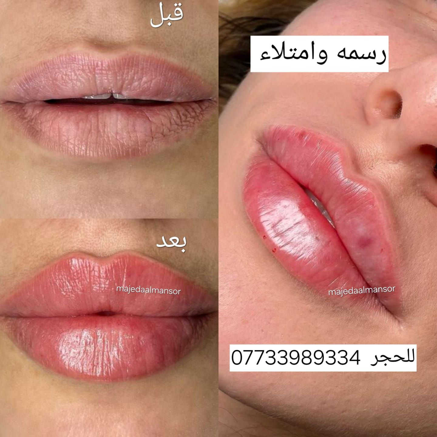 شفايف ممتلئة وطبيعية تخلي جمالج يبين من أول نظرة 💋
فيلر الشفاه عندنا بلمسة ناعمة ونتيجة تفتح النفس ✨
  الدكتورة ماجدة المنصور Jojo Alnabeel 
العنوان بغداد الحسينية مقابل السوق الكبير مجاور مرطبات العذراء
مجمع سما الحسينيه للطابق الثاني قسم التجميل والصالون ***********
