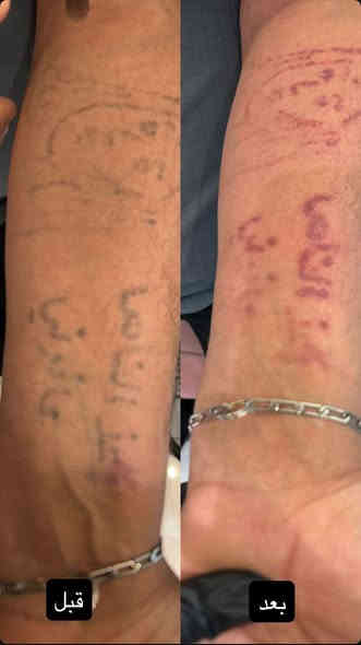 ازالة وشم من عياده سنايا
كربلاء - الجمعية
رقم الحجز ***********
