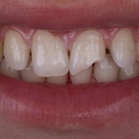 كسر أسنان أمامية • علاج مجاني • كربلاء الجمعية