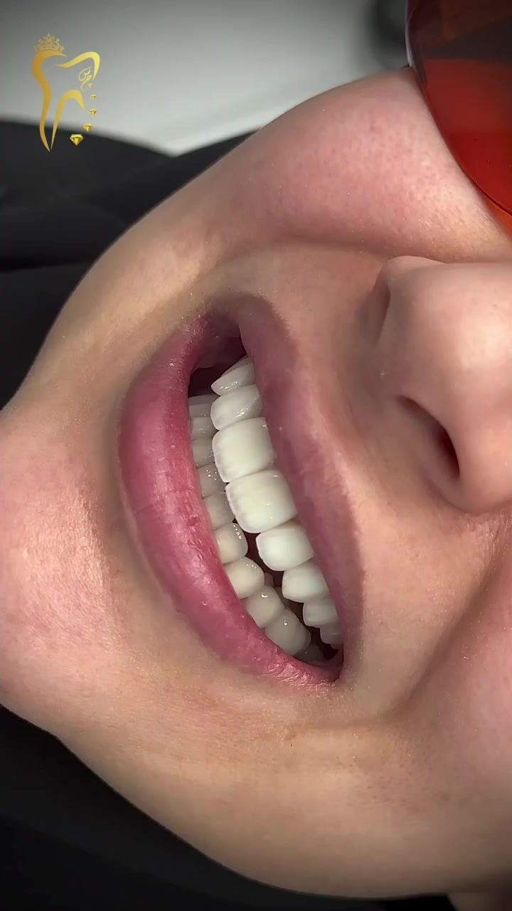 فرصة ما تتعوض

عالج أسنانك بخصومات خاصة لفترة محدودة

مراكز الشركة الطبية العالمية تمنحكم ابتسامة مشرقة 

#مراكز_الشركة_الطبية_العالمية #بغداد #تبييض_الاسنان #تقويم_اسنان #العراق

🔻
🏢 العنوان / بغداد _ الزعفرانية  الاربع شوارع _ مجاور مدرسة الاميرات ..
📲 للحجز والاستفسار 
***********
مركز_سما_الزعفرانية_لطب_وتجميل_الاسنان
