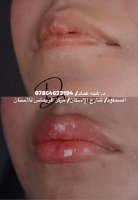 فيلر شفايف • مركز الريماس • د. هبة عماد