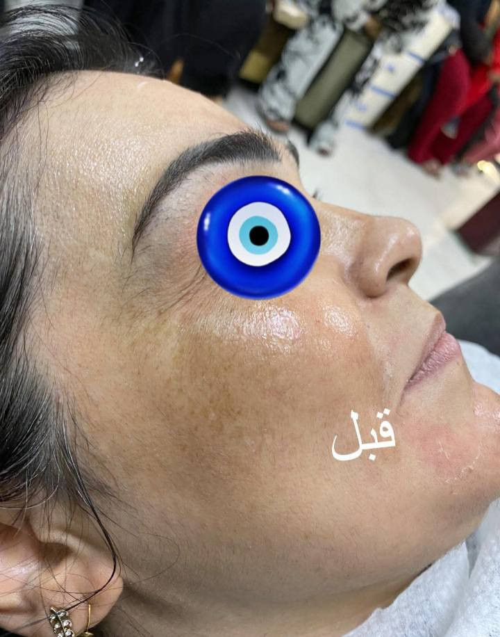 يعلن صالون الماكيره ميمي عن عروض بمناسبه عيد الاضحى تتضمن جميع ماتحتاجه البشره الشاحبه دللي نفسج من خلال زياره صالون هوى بغداد والحجز المسبق للعروض وتشمل الفقرات التاليه راح يكون سعر العرض فقط ٣٥ الف
١حف
٢تنضيف بشره ملكي
٣جلسه نضاره
٤ جلسه تبييض
٥ جلسه لازالت التصبغات
٦جلسه لمعالجة اثر حب الشباب
٧جلسه وتوريد 
كل هاي الفقرات ب٣٥ فقط
الحجز مسبق بدون احراج العنوان فلوجه شارع الجيش الشعبي مجاور اسواق ابو ناظم للاستفسار ***********
يعلن صالون الماكيره ميمي عن عروض بمناسبه عيد الاضحى تتضمن جميع ماتحتاجه البشره الشاحبه دللي نفسج من خلال زياره صالون هوى بغداد والحجز المسبق للعروض وتشمل الفقرات التاليه راح يكون سعر العرض فقط ٣٥ الف
