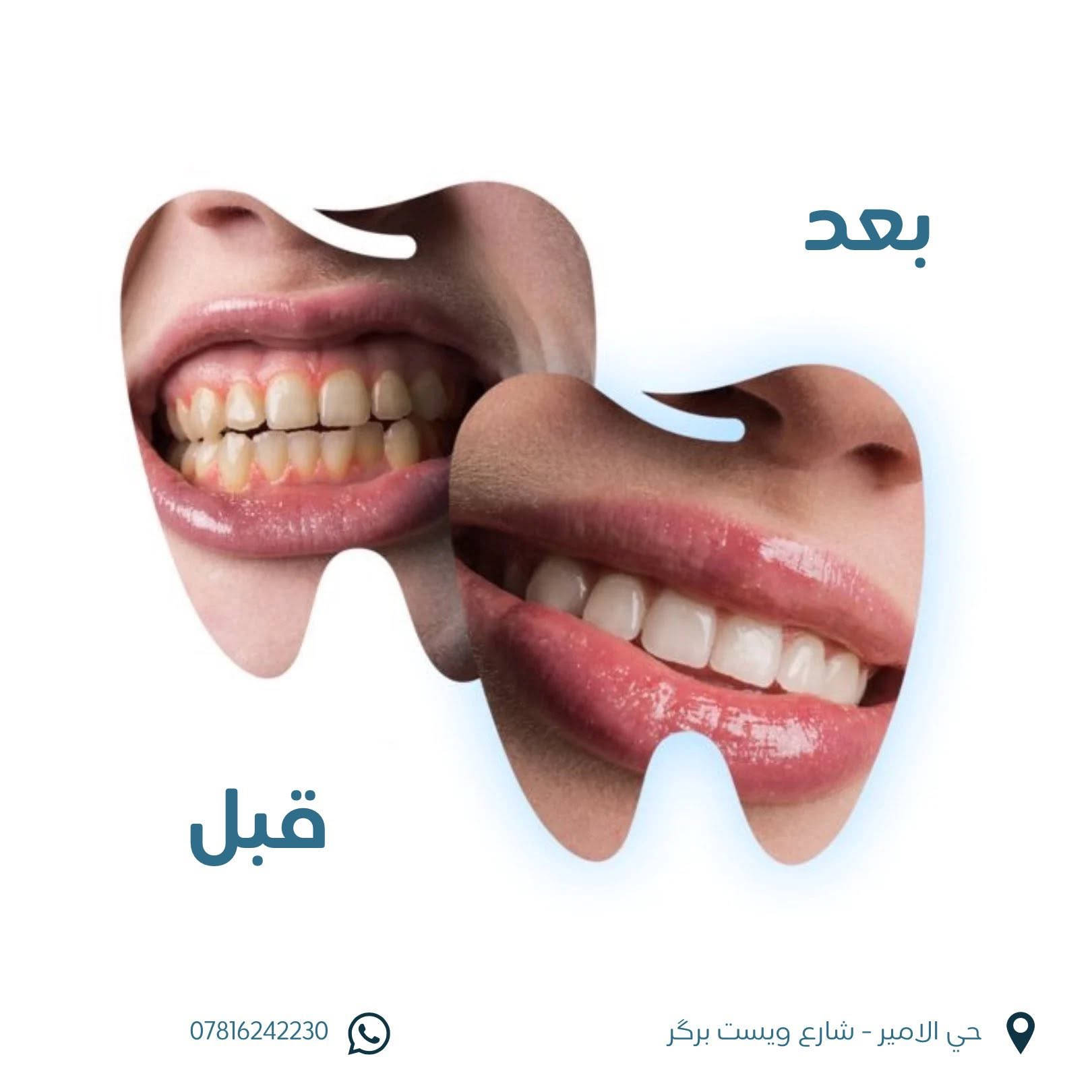نقدم لكم في عيادتنا مجموعة متكاملة من خدمات طب الأسنان:

✔️ معالجة تسوس الأسنان
✔️ قلع الأسنان المتضررة
✔️ تنظيف الأسنان وإزالة التكلسات
✔️ تبييض الأسنان
✔️ ابتسامة هوليوود
✔️ التركيبات الثابتة
✔️ زراعة الأسنان

💳 أسعار مناسبة وإمكانية الدفع على الجلسات

📍 الموقع: حي الأمير – شارع ويست برگر
📞 للحجز والاستفسار: ***********

✨ صحتك وابتسامتك تستحقان أفضل عناية… احجز موعدك الآن ودعنا نهتم بابتسامتك. 🦷💙
