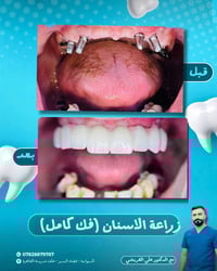 عيادة اسنان • زراعة اسنان • الديوانيه البدير