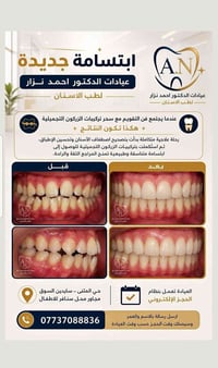 زيركون تجميلي • تقويم • بالمثنى