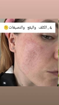 سيروم نياسيناميد • تصبغات • منتجات كورية