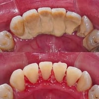 علاج مجاني • طب أسنان • عيادات جامعة الصفوة