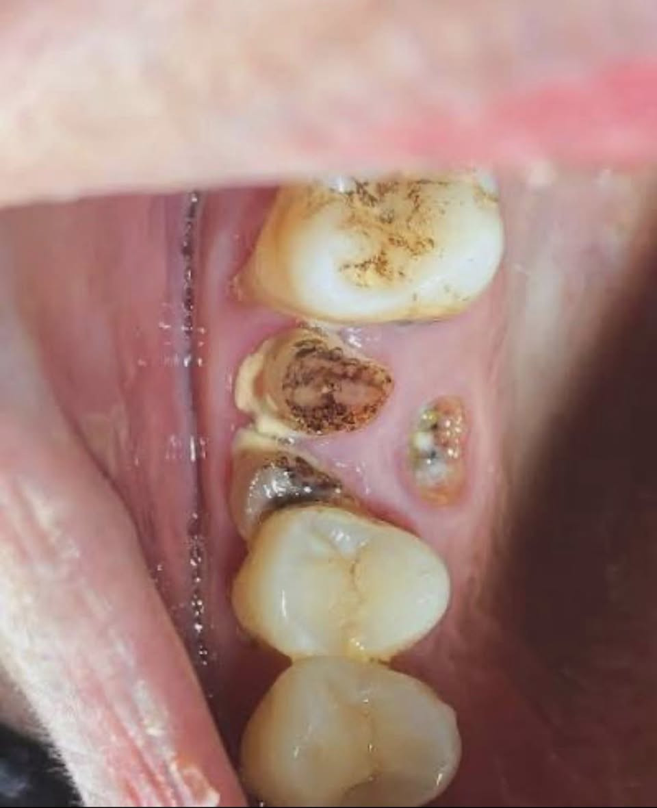 الي عنده جذور متبقيه وتالفه مثل الي معروضه بالصور
يتوفر قلع مجاني في عيادات جامعة الفراهيدي 
للتواصل  ***********
#طباسنان
