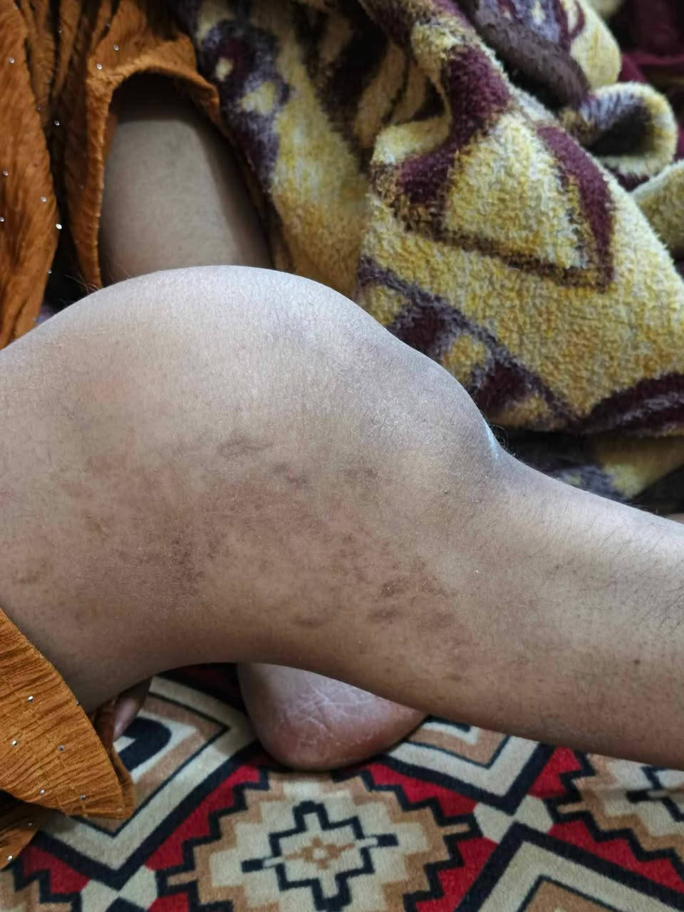 إلى أهل النخوة والرجاء
إلى أصحاب القلوب الرحيمة 
إلى كل مسلم ومسلمة إلى كل من وسّع الله عليه في رزقه إلى كل من يحمل همّ اخيه المسلم ويرجوا المغفرة والرضوان من الله عزّ وجل 
هذا يومكم لإنقاذ طفلة يتيمة الأم تصارع ألم سرطان في ركبتها يسرق طفولتها، وتحتاج منكم عوناً لإجراء عمليتها التي تكلف 22 مليون دينار، وهي الآن راقدة في مستشفى كربلاء تنتظر البشارة منكم لإكمال مبلغ عمليتها كونوا عوناً لها والله في عون العبد ما كان العبد في عون أخيه 
// لا تنسوا هي تنتظر قلوبكم الرحيمة//
لا تتركوا وجعها يكبر… ساهموا في علاجها ولو بالقليل
من يحب ان يتبرع عن طريق الماستر هذا رقم الماستر 

7284957169 #ماستركارد 

الرقم الهاتف‏‪***********‬‏

ساهموا ولو بالقليل

