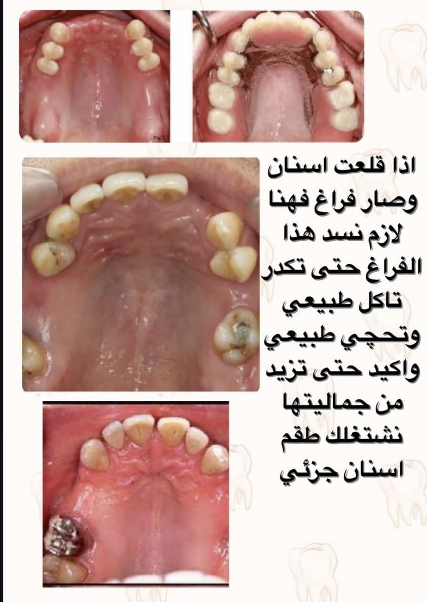 رجعنالكم بعروضنا المجانية الي ما تخلص ❤️‍🔥❤️‍🔥🔥🔥🔥
حشوات تجميلية
علاجات الاسنان للاطفال
حشوات جذور
قلع الاسنان التالفة
تنضيف التكلسات العنيدة 
طقم متحرك كامل
طقم متحرك جزئي
تعويضات فكية ثابتة
علاجات الاسنان للاطفال
كل هذذااا مجانننيييي 
سارعوا بالحجز يجماعة ولا تفوتون كل هاي العروض
الشغل يكون تحت ايد افضل الدكاترة المختصين 🔥🔥🔥🔥🔥🔥

للحجز على الماسنجر او الواتساب

***********

عيادات جامعة المنارة
