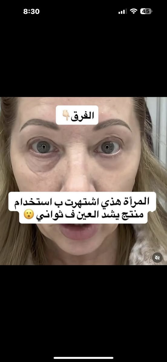 ✨ وصل كريم بيتر توماس روث المعجزة الامريكية لشد البشرة Peter Thomas Roth Instant FirmX Eye هو الحل السريع والفعّال لشدّ منطقة تحت العين والتخلّص من مظهر التعب، التجاعيد، والخطوط الدقيقة خلال دقائق!

هذا المنتج المصمّم بتقنية متطورة يشتغل فورًا على شدّ البشرة وتنعيمها، ويقلّل من مظهر الانتفاخ والهالات، ويخلي منطقة العين تبين أصغر سنًا، أنعم، وأكثر إشراقًا. أول ما تحطّيه، تحسّين بتأثير الشدّ الفوري، وتلاحظين فرق واضح بالملمس والشكل 😍

✨ مميزات المنتج:
شدّ فوري ومؤقّت لمنطقة تحت العين
يقلّل من مظهر التجاعيد والخطوط الدقيقة
يخفف الانتفاخ والهالات
يخلي البشرة ناعمة ومشدودة
مناسب لكل أنواع البشرة
مثالي قبل المكياج أو المناسبات


**إذا كنت صاحب هذا الإعلان وتريد حذفه لأي سبب، رجاءا أرسل رسالة إلى الدعم الفني**