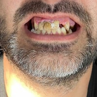 تعويض أسنان زاركون • عيادات الفرح حي النصر • ضمان مدى الحياة