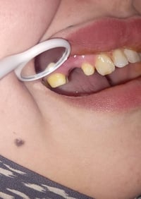 عيادات الفرح • جسر زركون ألماني • ضمان مدى الحياة