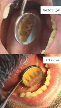 الي عنده سن متحرك او بقايا جذور اسنان والي يحتاج تنضيف اسنان  يراسلني ...