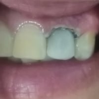 تاج سن • علاج جذر • القياره