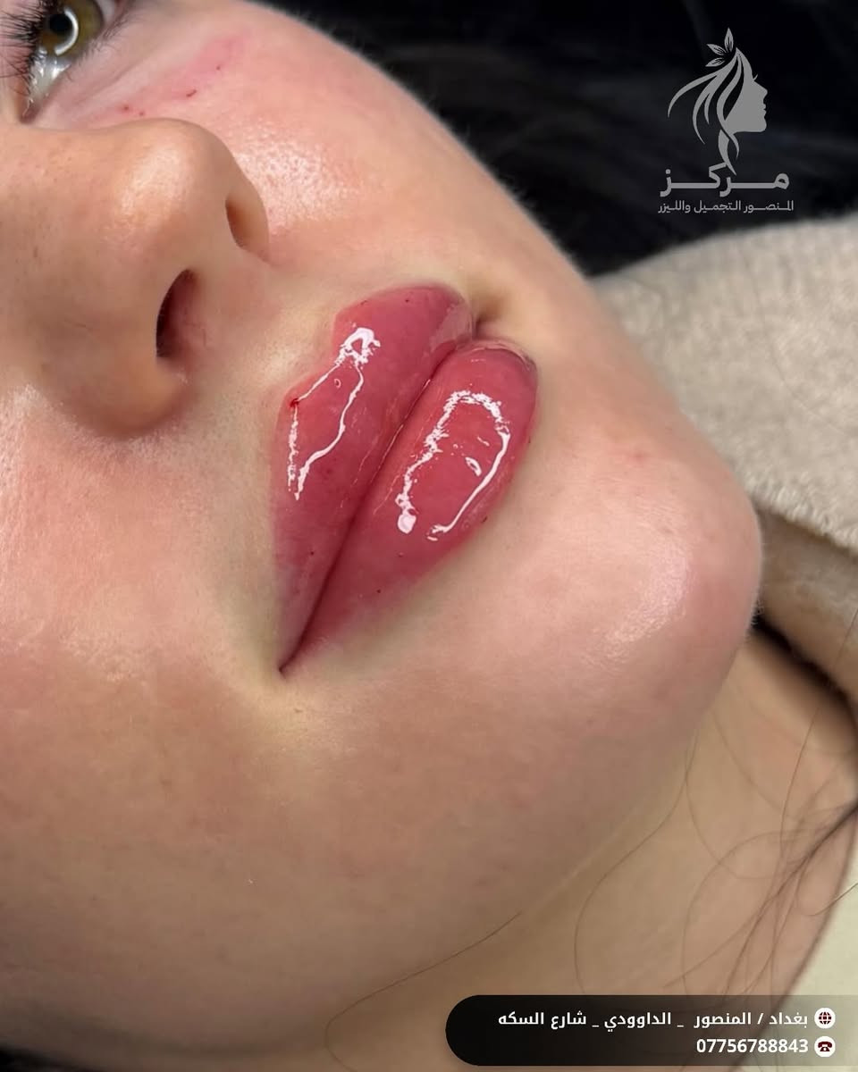✨ حقن فلر الشفاه
لشفاه ناعمة، ممتلئة وطبيعية 💋
🌸 تحديد شكل الشفاه بدقة
🌸 امتلاء طبيعي بدون تكتل
🌸 نتائج فورية وآمنة
مع الدكتورة مروه عادل كاظم 👩‍⚕️
📞 للحجز والاستفسار:
***********
📍 العنوان:
بغداد – المنصور – الداودي
مستشفى المنصور الجراحي – الطابق الرابع
