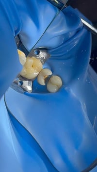 تم عمل حشوة تجميلية للسن واعادة رسم الشكل التشريحي للسن بجلسة واحدة فق...