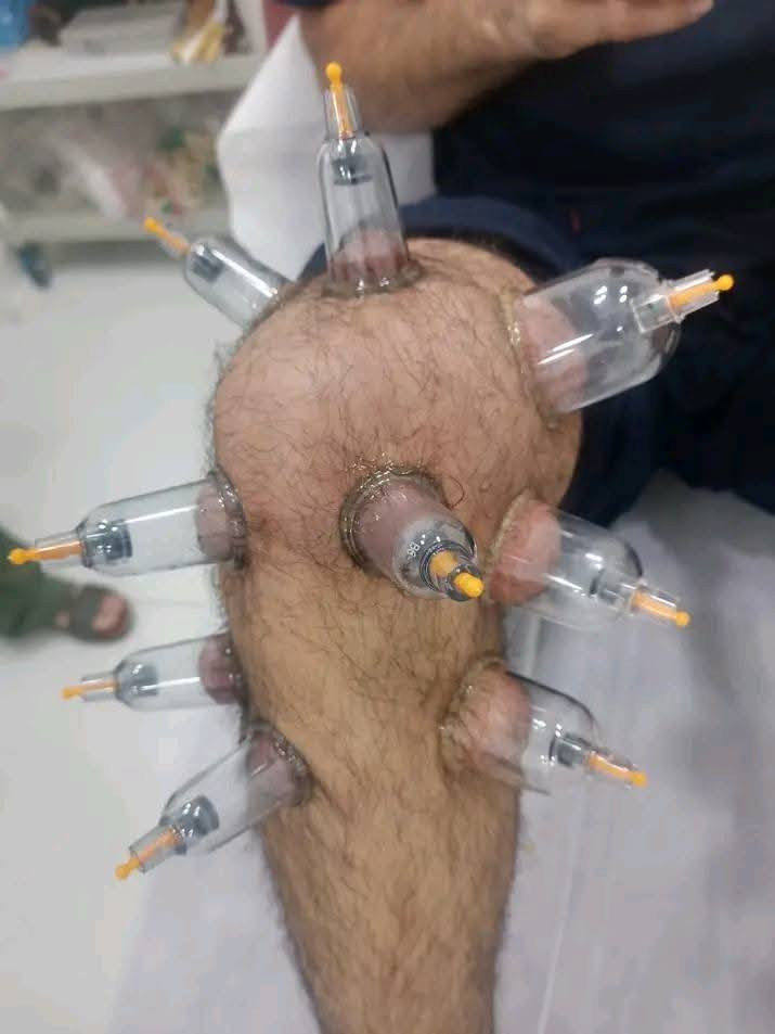 ♦️ التنويع في مواضع الحجامة … سرّ النتائج الأفضل ♦️
ليست الحجامة موضعًا واحدًا فقط ، بل هي علمٌ قائم على اختيار المكان المناسب حسب الحالة ، وكل موضع له تأثير خاص على الجسم .

🔹 الحجامة على الرقبة والرأس :
✔ تخفيف الصداع المزمن
✔ تقليل التوتر والقلق
✔ تحسين التركيز وصفاء الذهن
✔ تنشيط الدورة الدموية في الدماغ

🔹 الحجامة على الظهر :
✔ تخفيف آلام الظهر والكتفين
✔ تنشيط الدورة الدموية العامة
✔ تحسين عمل الجهاز العصبي
✔ تقوية الجسم واستعادة النشاط

🔹 الحجامة على البطن والصدر :
✔ تحسين الهضم وعلاج القولون والخلعة 
✔ تخفيف الانتفاخ والغازات
✔ دعم عمل الجهاز التنفسي
✔ تنظيم بعض وظائف الجسم الداخلية

🔹 الحجامة على الأطراف العلوية :
✔ تخفيف آلام الذراعين والمفاصل
✔ تحسين تدفق الدم لليدين
✔ تقليل التنميل والخدر

🔹 الحجامة على الأطراف السفلية :
✔ تحسين الدورة الدموية في الساقين
✔ تخفيف آلام الركب والمفاصل
✔ تقليل الثقل والتعب في الأرجل

✨ التنويع في مواضع الحجامة يعطي نتائج أدق وأفضل حسب حالة كل شخص .

العنوان : ابو غريب العمارات السكنيه عماره ٧ على ١٠
📞 الهاتف ***********
***********
#يتوفر_لدينا_كادر_نسائي_متخصص
