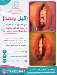 تجميل سن أمامي • حشوة جذر جلسة واحدة • المحمودية