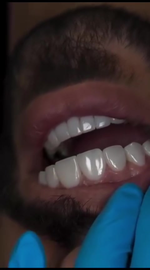 ✨ ابتسامتك تستحق الأفضل ✨

مع أحدث تقنيات تجميل الأسنان، نمنحك ابتسامة ناصعة وجذابة بكل ثقة 😁🦷
✔️ تبييض الأسنان
✔️ عدسات الفينير
✔️ تقويم وتجميل الابتسامة
✔️ حشوات تجميلية بأفضل جودة

احجز موعدك الآن واستعد لابتسامة تخطف الأنظار 🌟
📍 جودة عالية – نتائج مميزة – عناية متكاملة

راسلنا للاستفسار والحجز 📩
العنوان / النجف الاشرف _ المناذرة _ الشارع العام _ قرب مستشفى
 المناذرة _عمارة الحاج ابو نبيل جانب صيدلية الأصالة
 للحجز والأستفسار / ***********
الساعه 8:00 صباحا الساعه 12:00 ظهرا من الساعه 3:00 ظهرا الى الساعه 9:00 ليلا ًَ

#تقويم_اسنان #زراعة_اسنان #صحة_الفم #مراكز_الشركة_الطبية_العالمية #زراعة_الاسنان
