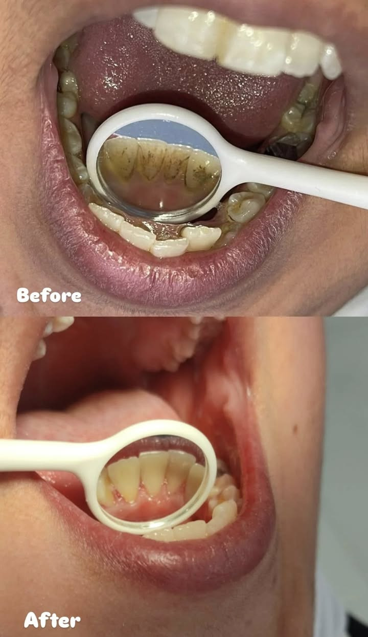 🦷 علاج أسنان مجاني 100%! لفترة محدودة ⏳

#حشوات تجميلية بجلسة واحدة  
#تنظيف اسنان | #قلع الاسنان والجذور التالفه | #تقويم اسنان   
#تعويض أسنان (فك كامل أو فكين)  
علاج مشاكل أسنان #الأطفال بالكامل👶  

👩‍⚕️ بإشراف أطباء اختصاص  ✨ أجهزة وتقنيات حديثة  

📍 #شارع 40 – مجاور صيدلية سلامتك أولاً  

📲 واتساب: ***********  

📸 الصور نماذج من شغلنا
