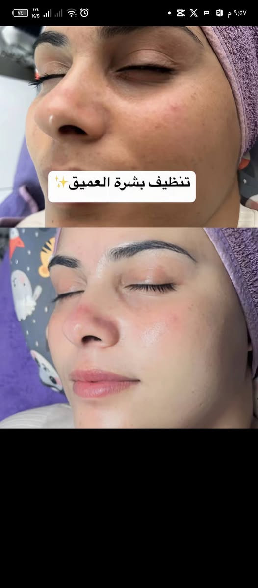 عرض 🔥 تنضيف بشرة بل اجهزة وحفافه بس ب5الف وميش وصبغ شعر+معالج ب20
***********واتساب
