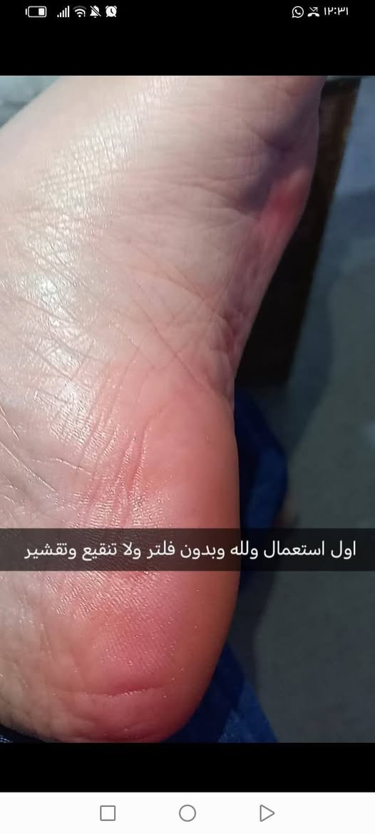 معالج القدم الأصلي ✨ 3 قطع ب14 وتوصيل مجاني وحجم كبير يكفي اكثر من شهر والله ع مفعوله يسوه اكثر 
مو كالوس ولا كريم يقشّر ويخلي الجلد رقيق ويتعب القدم 👎
هذا معالج علاجي مليان زيوت عشبية وزبدات وكريمات مغذّية
يرمّم الجلد من الداخل ويرجّع له صحته وقوّته 👣
💧 بيه يوريا ترطّب أعماق الجلد
من أول استعمال الفرق يبين
تشقق؟ خشونة؟ جفاف؟ يختفون
👶 القدم تصير قدم بيبي
لون وردي خفيف وطبيعي
مو بس من جوّه… حتى من فوگ ينطي تفتيح ونظافة ولمعة ✨
حتى الأظافر تصير ورديّة وتلمع
عبالك صبغ أظافر ✨ وبدون ما يمنع الوضوء 😂
🔥 أتحدّى وحدة جربته وما شافت فرق من أول مرة
جربيه وراح تعرفين شنو يعني علاج مو بس ترطيب


**إذا كنت صاحب هذا الإعلان وتريد حذفه لأي سبب، رجاءا أرسل رسالة إلى الدعم الفني**